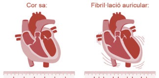 Tinc una arrítmia, però això què és? arritmia
