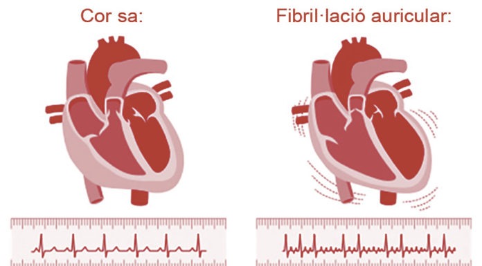 Tinc una arrítmia, però això què és? arritmia