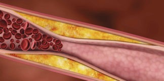 Hipertensió, “cuidem les nostres artèries”