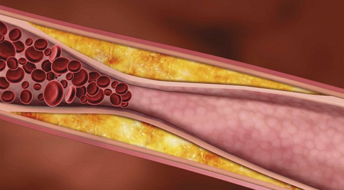 Hipertensió, “cuidem les nostres artèries”
