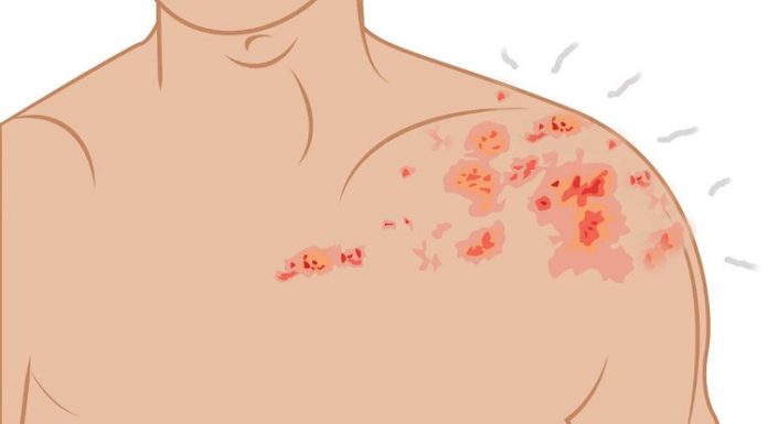 LA VACUNA DE L’HERPES ZOSTÈR